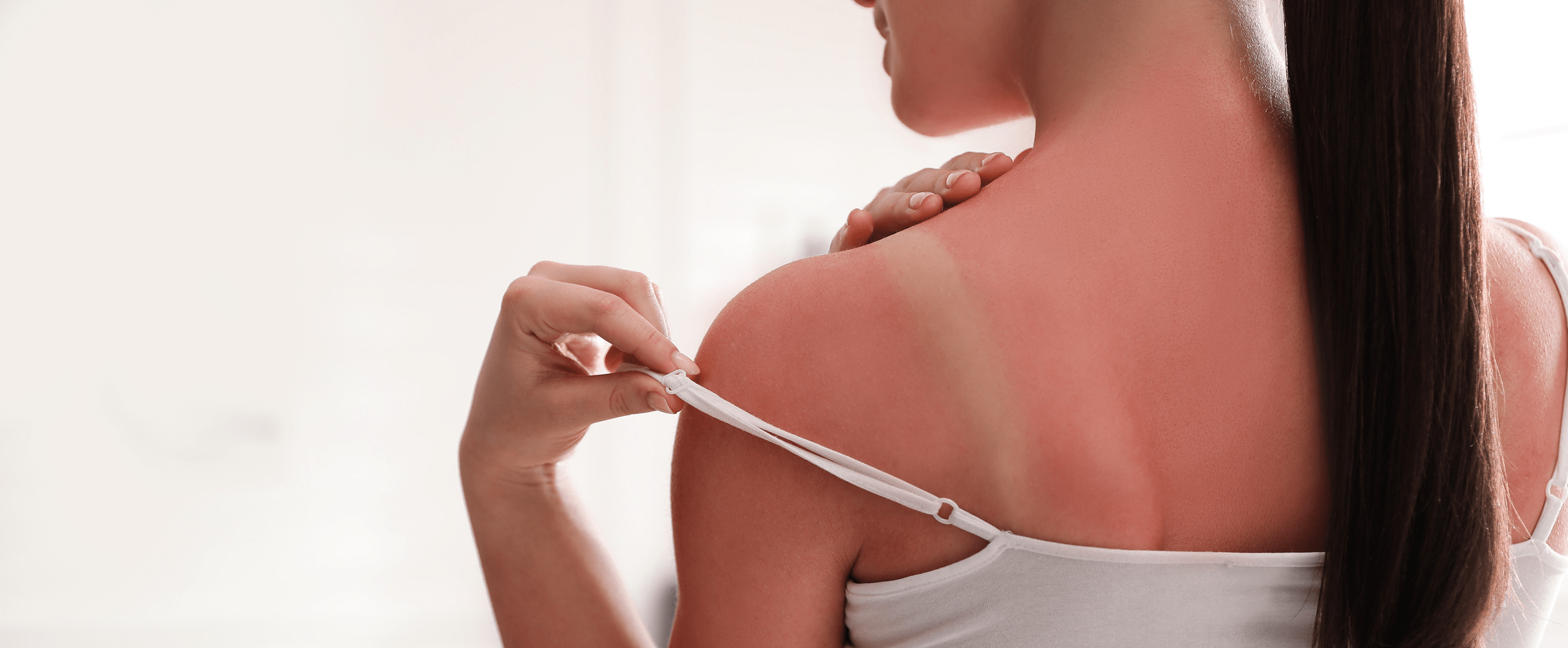 what-is-sunburn-and-what-symptoms-can-occur-eucerin